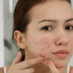 Tips dan Trik Skincare untuk Membantu Mengatasi Masalah Jerawat